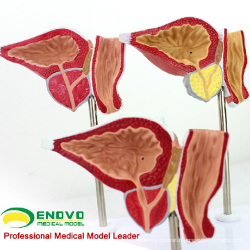 SELL 12427 Pathological Human Prostate Model for Education, BPH Prostate Examination Model